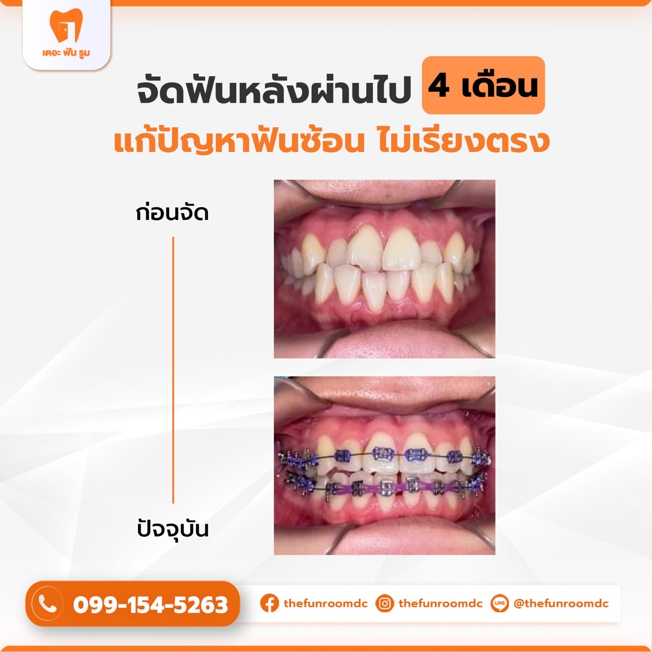 รีวิวจัดฟัน